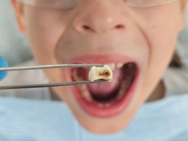 Best Emergency Dental Care for Sports Injuries in Carlinvle, IL